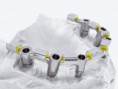 /album/estheticproteseodontologica/a325-54126hader-bar-nylon-clips-jpg/